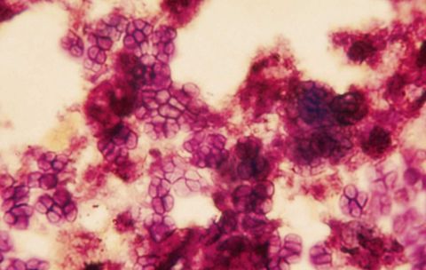 Gram negative Acinetobacter cells in clusters, pink and purple stain