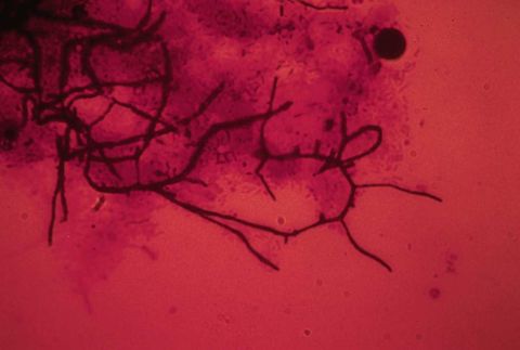 Branched dark nocardioform filaments, Gram stain